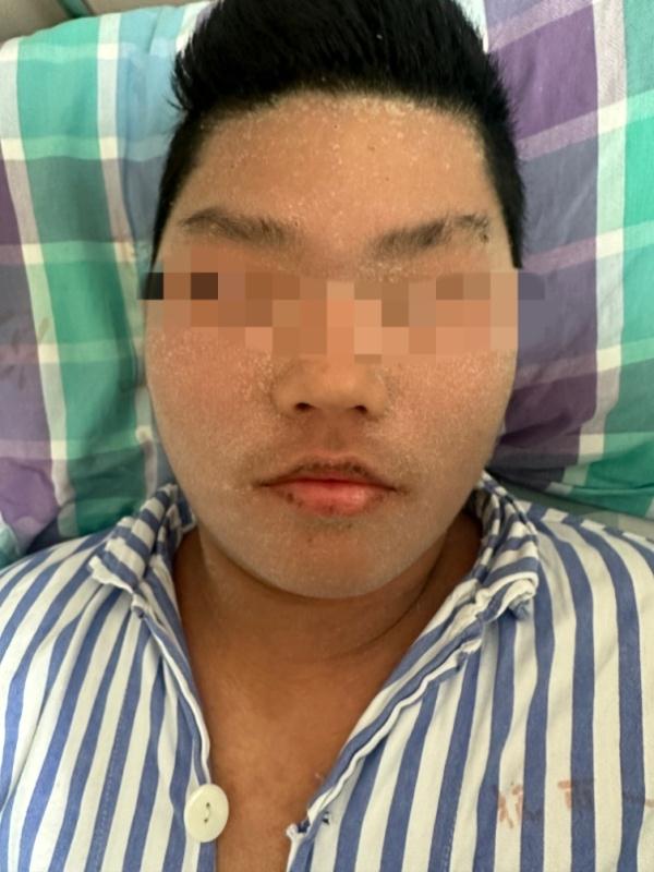 杭州一男生全身皮肤溃烂,只因吃了几口这种水果!眼下正大量上市 杭州一男生全身皮肤溃烂,只因吃了几口这种水果!眼下正大量上市