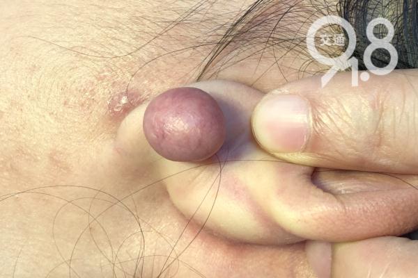 这个"肉疙瘩"是啥？爱美姑娘一个常见举动…崩溃