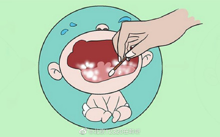 如何治疗婴幼儿鹅口疮？