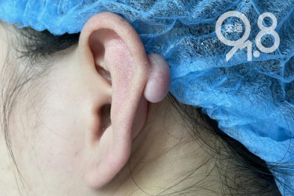 这个"肉疙瘩"是啥？爱美姑娘一个常见举动…崩溃