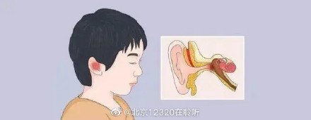 如何预防真菌性外耳道炎？