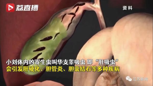 可怕！女子胆囊结石复发就医，术中取出10条活虫！或因这个爱好……