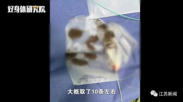 可怕！女子胆囊结石复发就医，术中取出10条活虫！或因这个爱好……