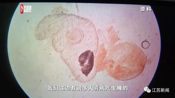 可怕！女子胆囊结石复发就医，术中取出10条活虫！或因这个爱好……