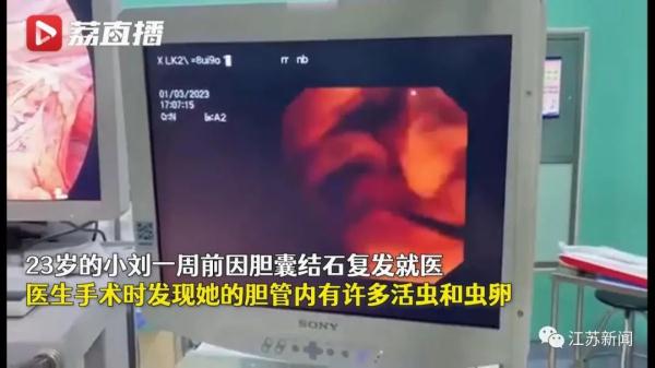 可怕！女子胆囊结石复发就医，术中取出10条活虫！或因这个爱好……