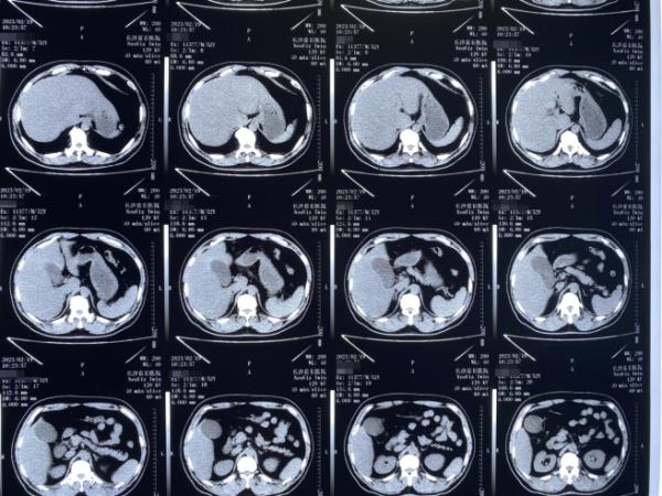 男子工作忙碌常误饭点,胆囊长出25颗“玉米粒”状结石 男子工作忙碌常误饭点,胆囊长出25颗“玉米粒”状结石