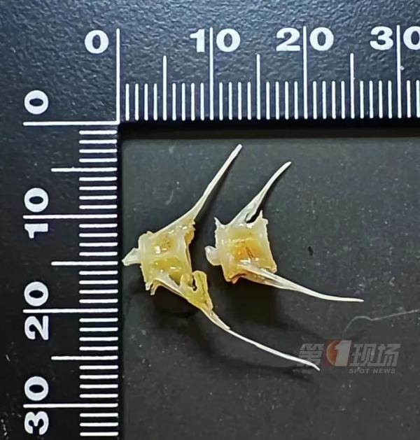 心惊!女子吃零食被卡,鱼骨距离主动脉仅3.5毫米… 心惊!女子吃零食被卡,鱼骨距离主动脉仅3.5毫米…