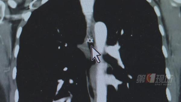 心惊!女子吃零食被卡,鱼骨距离主动脉仅3.5毫米… 心惊!女子吃零食被卡,鱼骨距离主动脉仅3.5毫米…