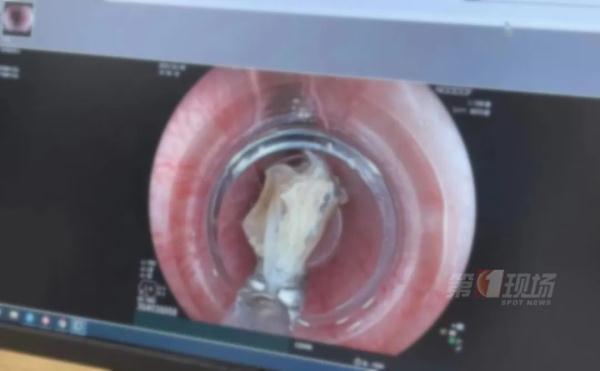 心惊!女子吃零食被卡,鱼骨距离主动脉仅3.5毫米… 心惊!女子吃零食被卡,鱼骨距离主动脉仅3.5毫米…