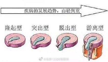 腰椎间盘突出有哪些类型？