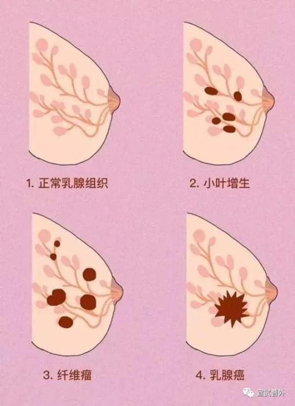 乳腺纤维腺瘤,可怕吗? 乳腺纤维腺瘤,可怕吗?