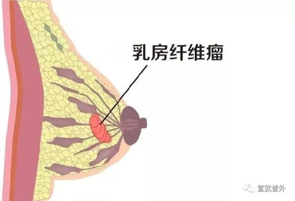乳腺纤维腺瘤,可怕吗? 乳腺纤维腺瘤,可怕吗?