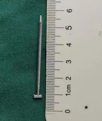 男子精神病发作将9枚钢钉钉入脑中,医生4小时手术全部取出助其脱险 男子精神病发作将9枚钢钉钉入脑中,医生4小时手术全部取出助其脱险