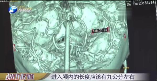 揪心！6岁女孩遭筷子戳眼，直插大脑9cm！事发时家长就在身边……