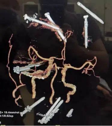男子精神病发作将9枚钢钉钉入脑中,医生4小时手术全部取出助其脱险 男子精神病发作将9枚钢钉钉入脑中,医生4小时手术全部取出助其脱险