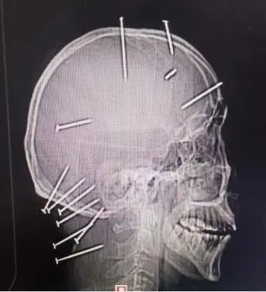 男子精神病发作将9枚钢钉钉入脑中,医生4小时手术全部取出助其脱险 男子精神病发作将9枚钢钉钉入脑中,医生4小时手术全部取出助其脱险