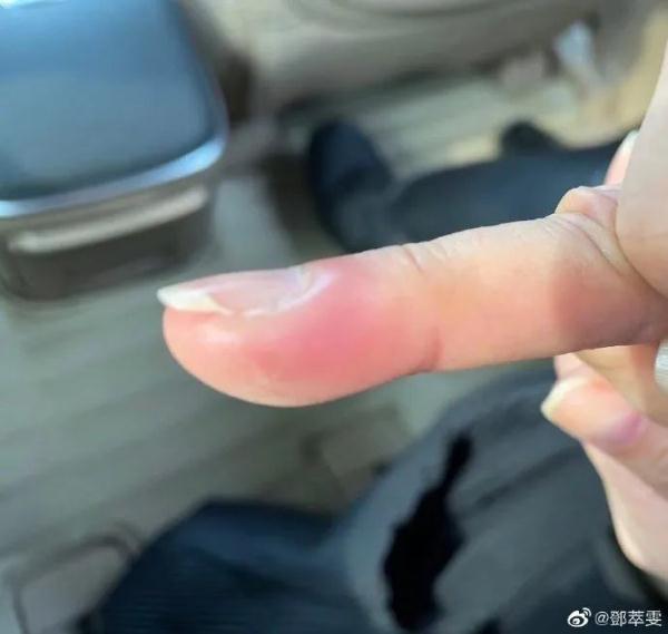 男孩手指险些被截！这个习惯，你可能也有