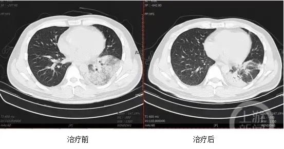 西南医院接诊一例“鹦鹉热”患者，专家提醒