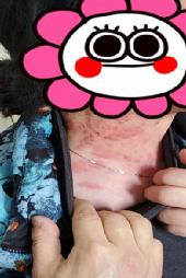 “衣服摩擦都觉得痛！”超90%成人体内都潜伏这病毒，一旦感染终身携带！