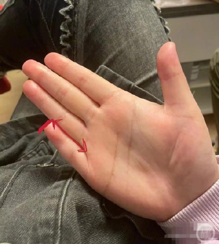 多人称患上短指症 医生:三种手术可治疗 多人称患上短指症 医生:三种手术可治疗