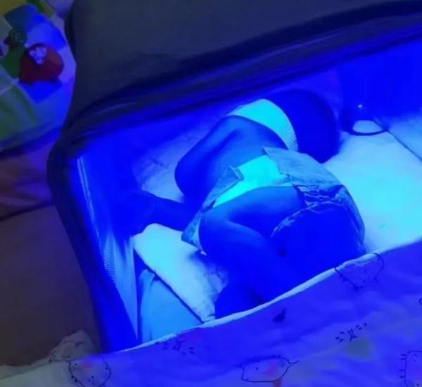 网购婴儿蓝光灯在家给宝宝去黄疸？当心操作不慎伤到宝宝