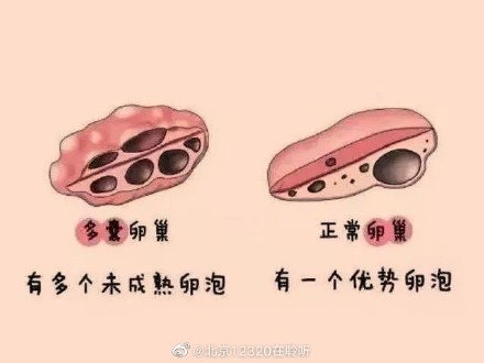 多囊卵巢综合征患者为什么要补充维生素Ｄ？