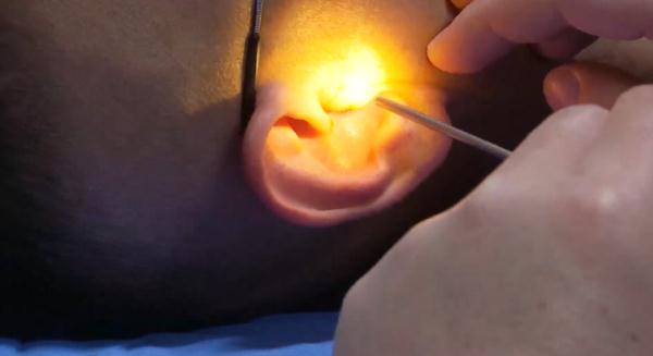 幼年游泳耳朵进水不在意或掏耳朵太用力，导致鼓膜穿孔，他们能恢复听力吗？