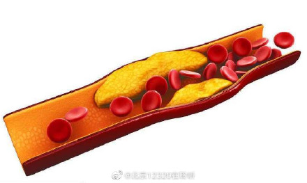血管中的斑块，可以被溶解或者吸出来吗？