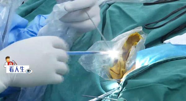 幼年游泳耳朵进水不在意或掏耳朵太用力，导致鼓膜穿孔，他们能恢复听力吗？