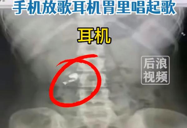 嘶~小伙误吞蓝牙耳机，结果肚子会唱歌？!
