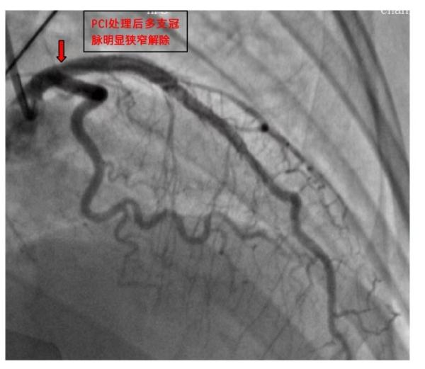 生活规律爱运动却患上急性心梗？中青年女性需警惕！