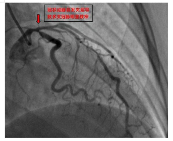 生活规律爱运动却患上急性心梗？中青年女性需警惕！