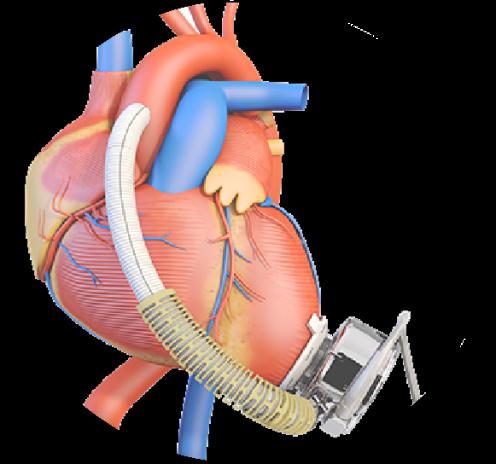 福建首例！全球最小全磁悬浮人工心脏植入者出院