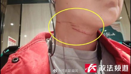 注意！近期千万小心风筝线割喉→