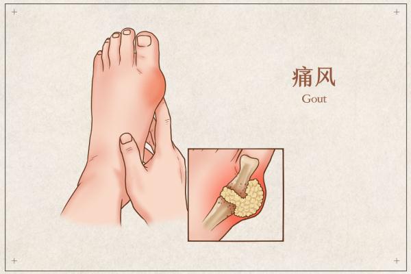 这些蔬菜竟是隐形的“嘌呤大户”