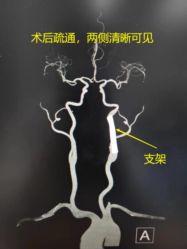 危险！危险！广东一女子按摩后突发急性脑梗，医生：这位置千万别按！