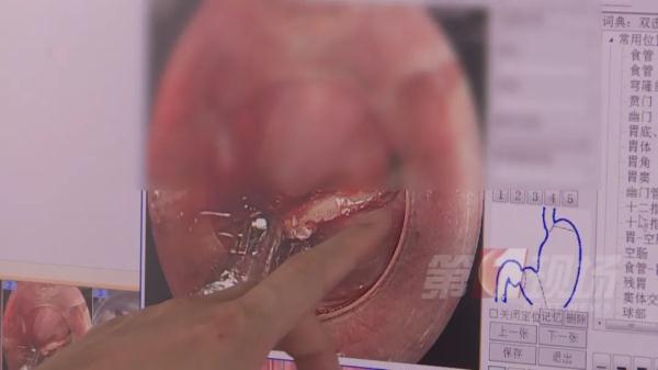 3厘米鱼骨卡喉！男子“土办法”处理险送命...