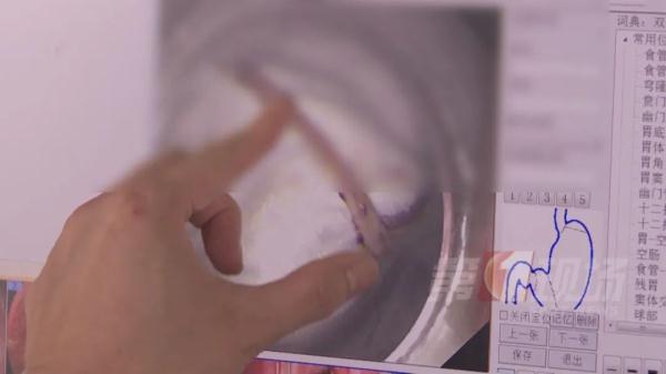 3厘米鱼骨卡喉！男子“土办法”处理险送命...