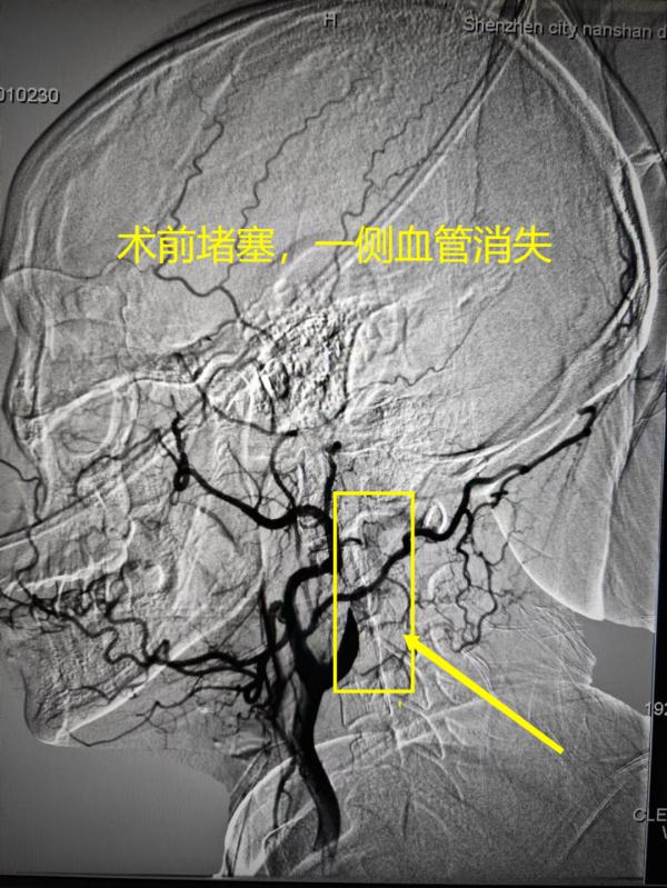 危险！危险！广东一女子按摩后突发急性脑梗，医生：这位置千万别按！