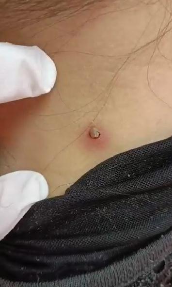 紧急提醒：它又来了！严重可致命！宁波已有人中招