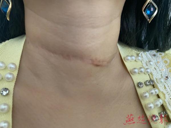 风筝线横跨两树间 一女子颈部被割伤