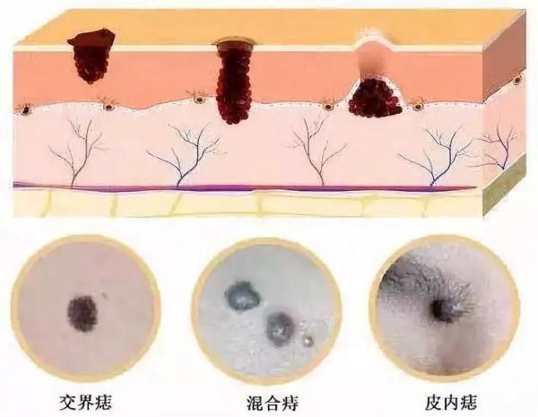 点痣可能致癌？遇到这5种情况赶紧上医院！