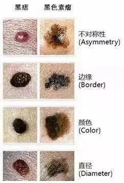 点痣可能致癌？遇到这5种情况赶紧上医院！