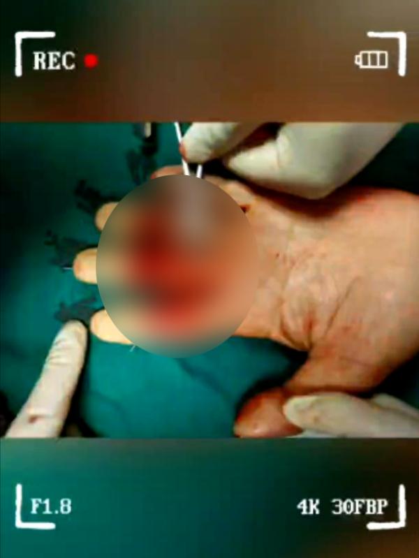 太可怕!厦门一面馆老板3根手指被切断!只因…… 太可怕!厦门一面馆老板3根手指被切断!只因……