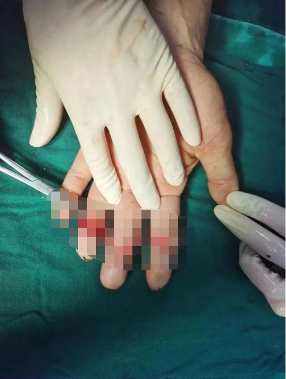 太可怕!厦门一面馆老板3根手指被切断!只因…… 太可怕!厦门一面馆老板3根手指被切断!只因……