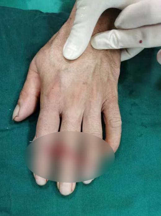 太可怕!厦门一面馆老板3根手指被切断!只因…… 太可怕!厦门一面馆老板3根手指被切断!只因……