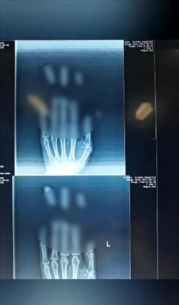 太可怕!厦门一面馆老板3根手指被切断!只因…… 太可怕!厦门一面馆老板3根手指被切断!只因……