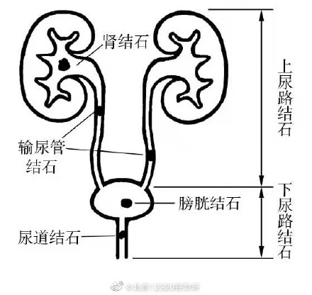尿路结石患者饮食攻略