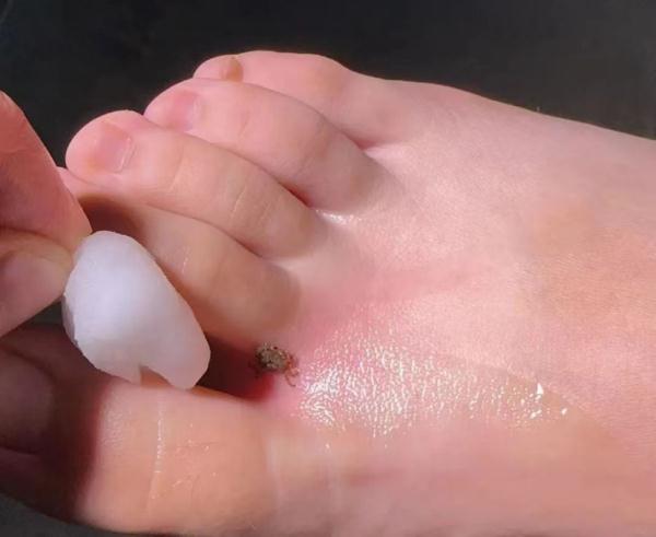 虫子钻脚趾、12cm钉子扎腰里?露营风正劲,这些隐患很致命!现场实探 虫子钻脚趾、12cm钉子扎腰里?露营风正劲,这些隐患很致命!现场实探