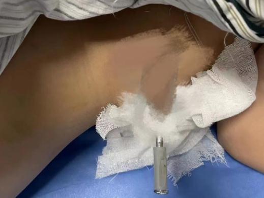 虫子钻脚趾、12cm钉子扎腰里?露营风正劲,这些隐患很致命!现场实探 虫子钻脚趾、12cm钉子扎腰里?露营风正劲,这些隐患很致命!现场实探